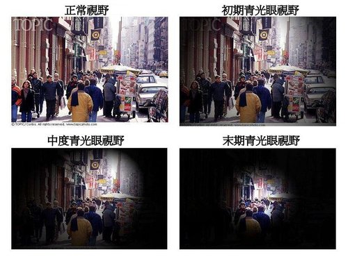 青光眼症狀(病徵)有哪些?